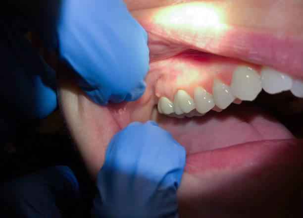 Best Emergency Treatment for Dental Infections or Abscesses in Shelton, WA